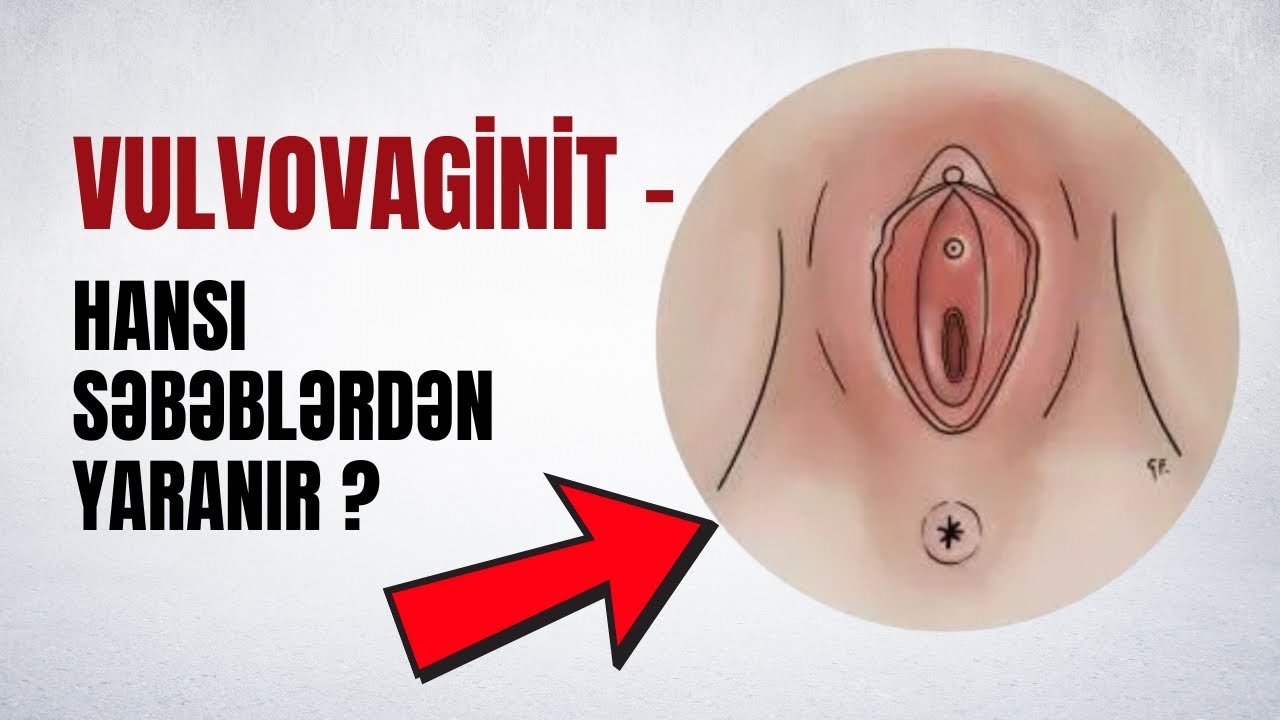 Vulvovaginit  - Ən çox rast gəlinən səbəblər və qorunma yolları!