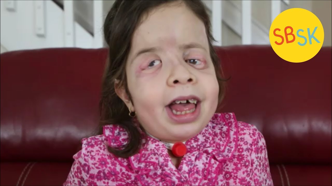 Life with Crouzon Syndrome (Judge Me By My Heart Not My Looks)