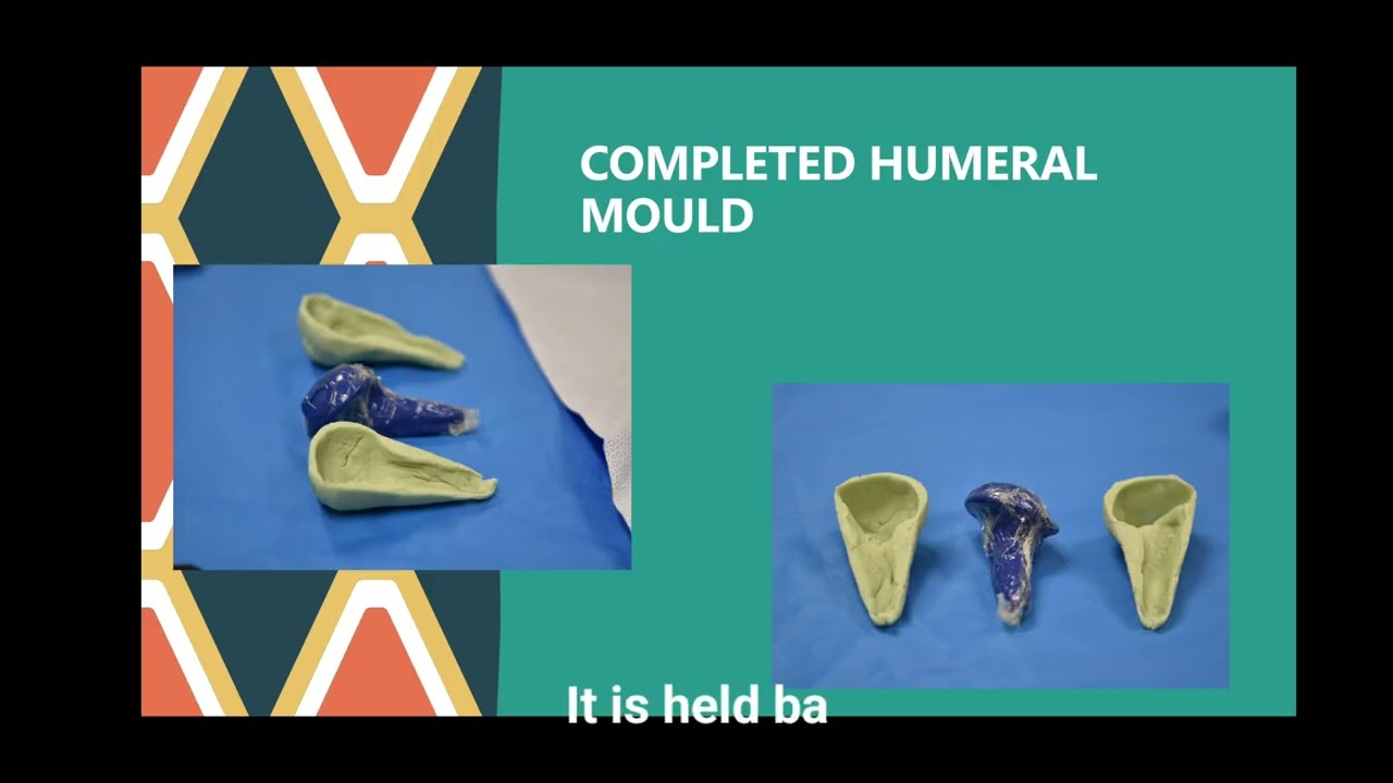 'ROTI' SHOULDER CEMENT SPACER - AN ANTIBIOTIC CEMENT SPACER TECHNIQUE WHEN ALL ELSE FAILS