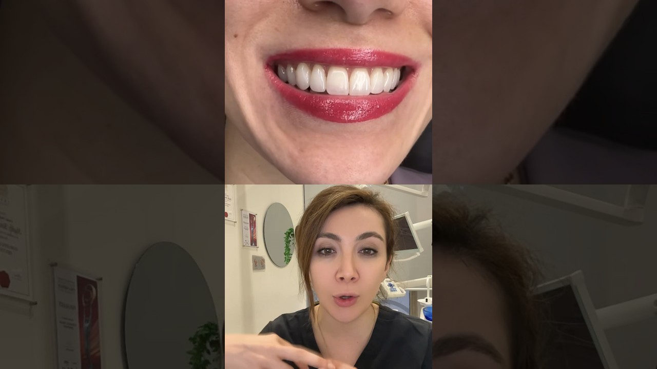 Getting Composite Bonding For Front Teeth!!