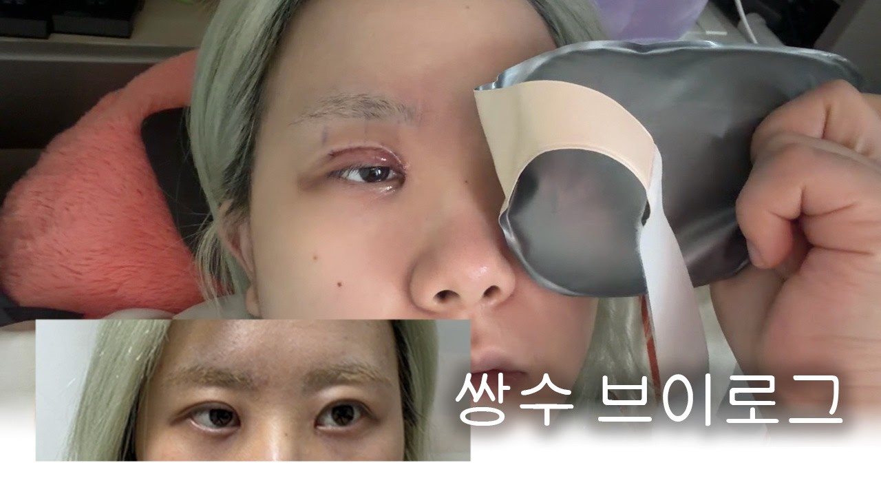 쌍수브이로그 (사실앞트임이랑눈매교정도했어요)