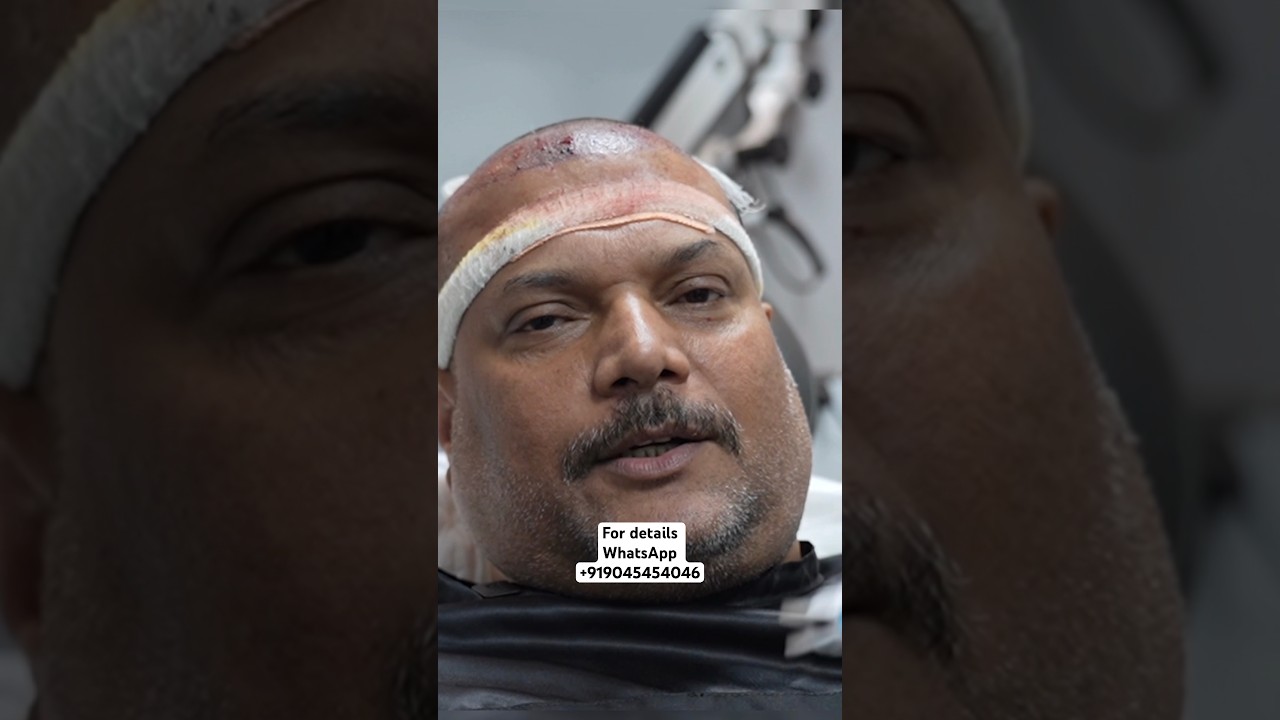 CID Actor Daya Hair Transplant Result #celebrityhairtransplant #hair #bollywood #viral