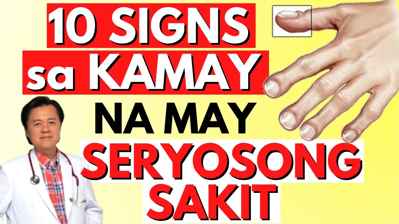 10 Signs sa Kamay na May Seryosong Sakit - Payo ni Doc Willie Ong