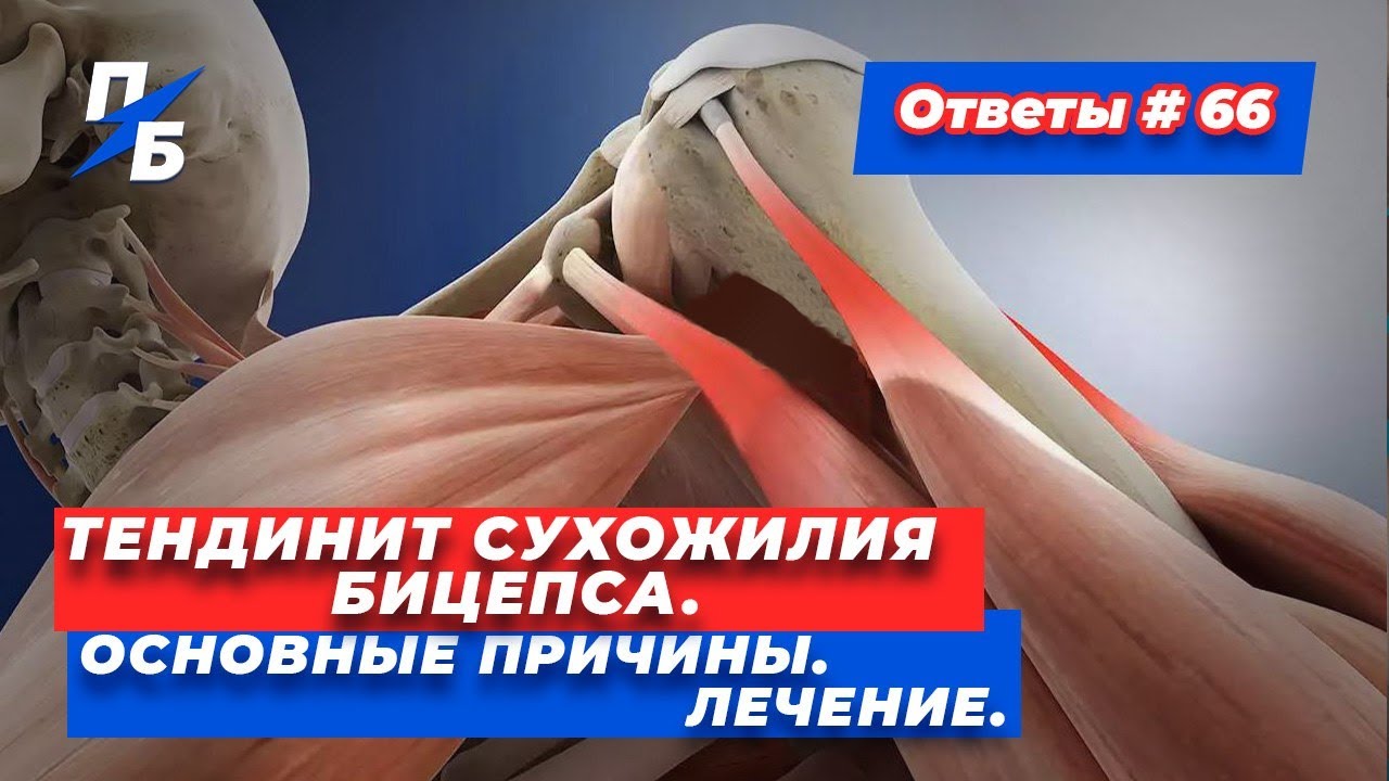 Тендинит сухожилия бицепса. Основные причины. Лечение. Ответы 66