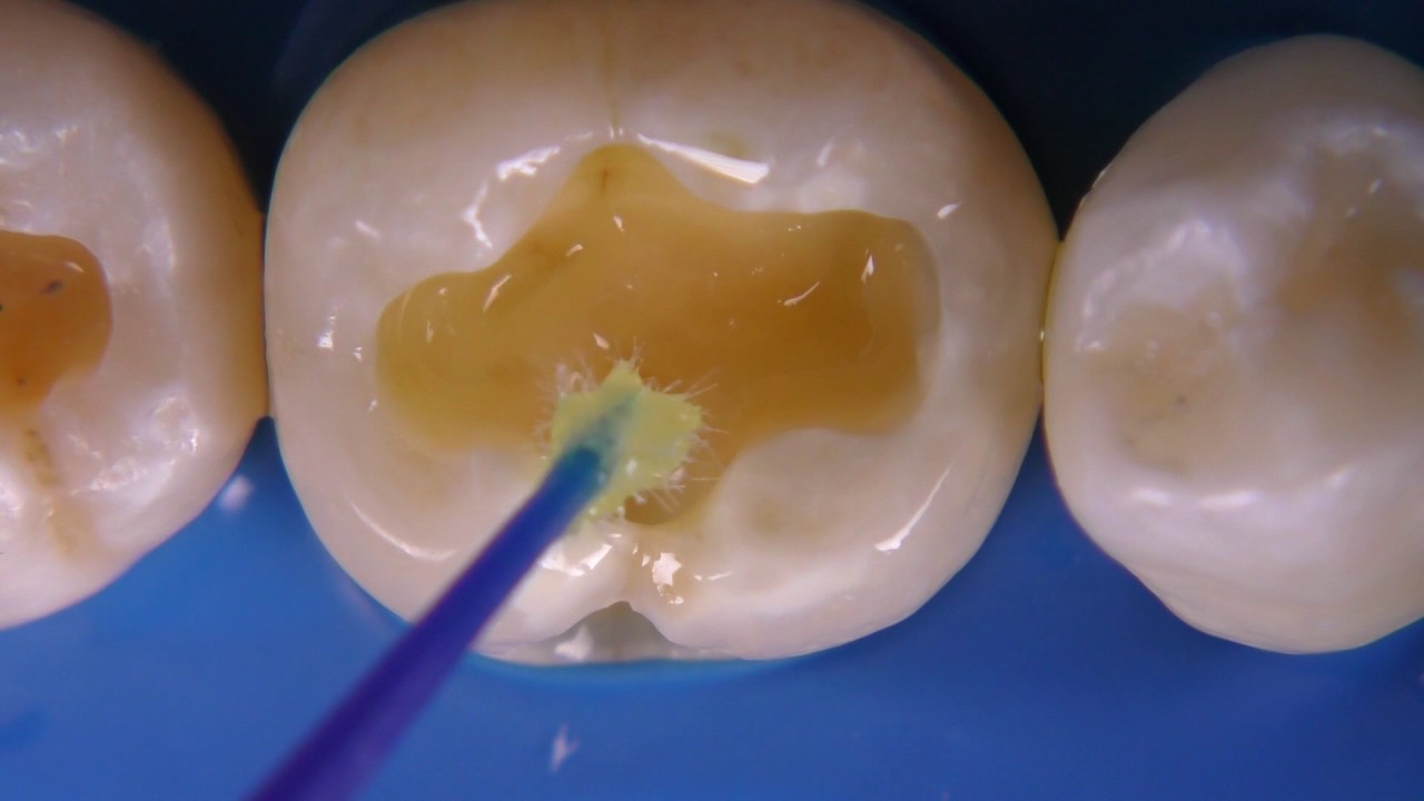 three step etch & rinse adhesives