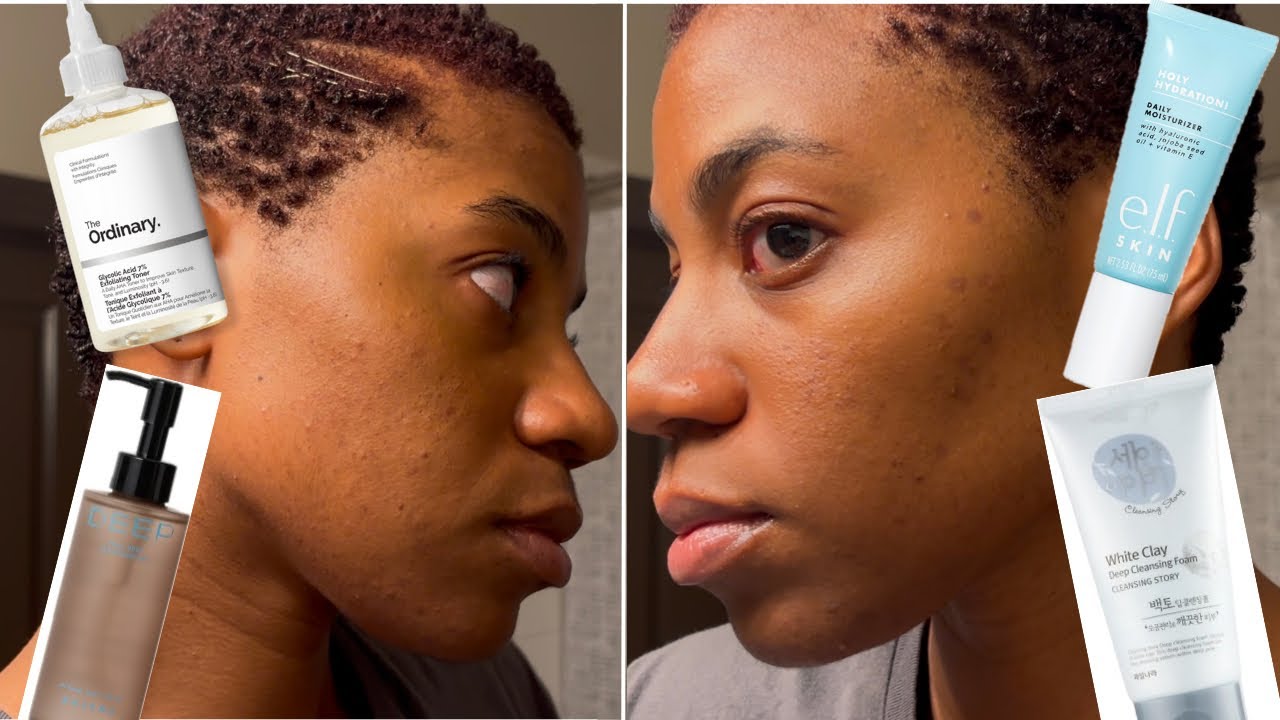 Hyperpigmentation & Breakout routine (using the ordinary glycolic acid toner)