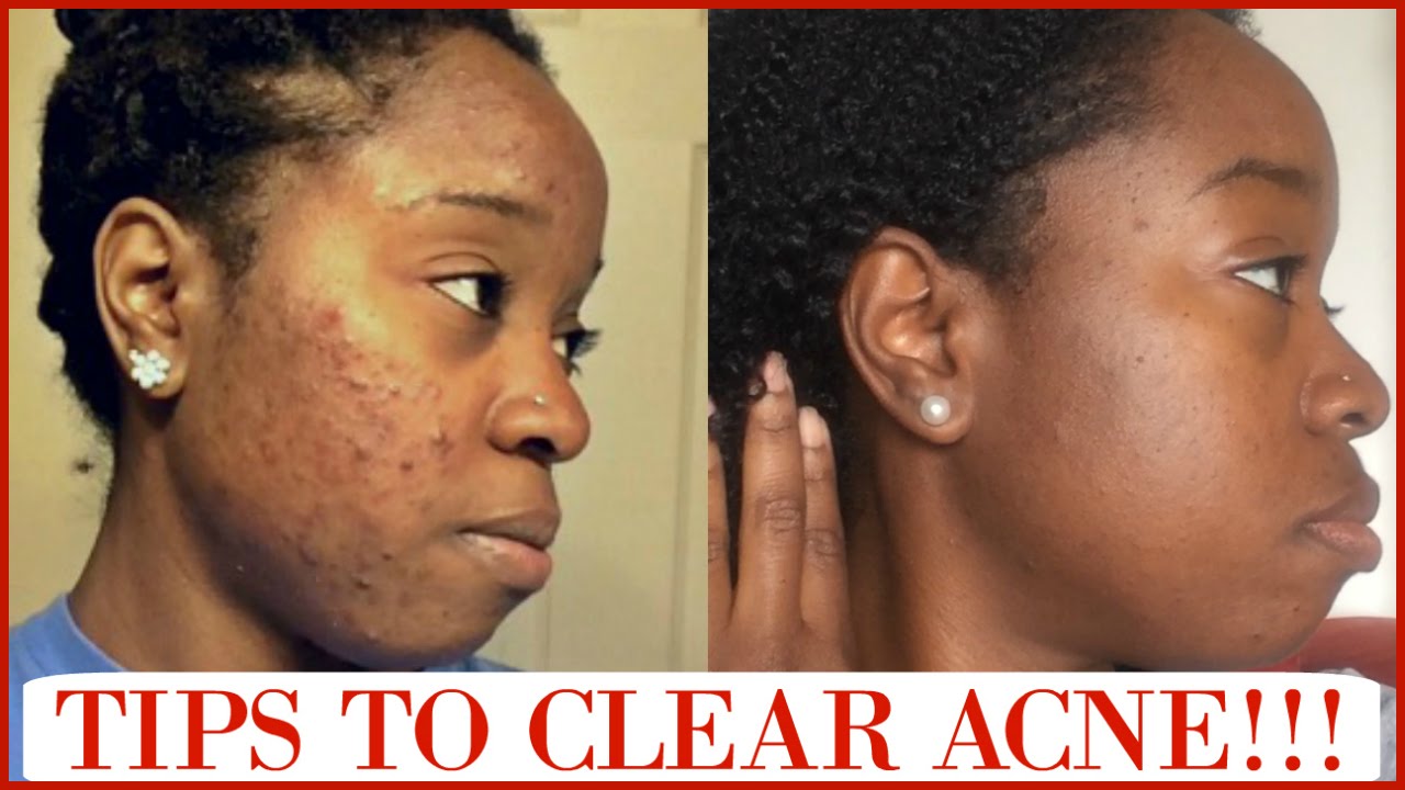 Tips For Clear Skin + What Caused My Acne + All About Retin-A!!! Q&A