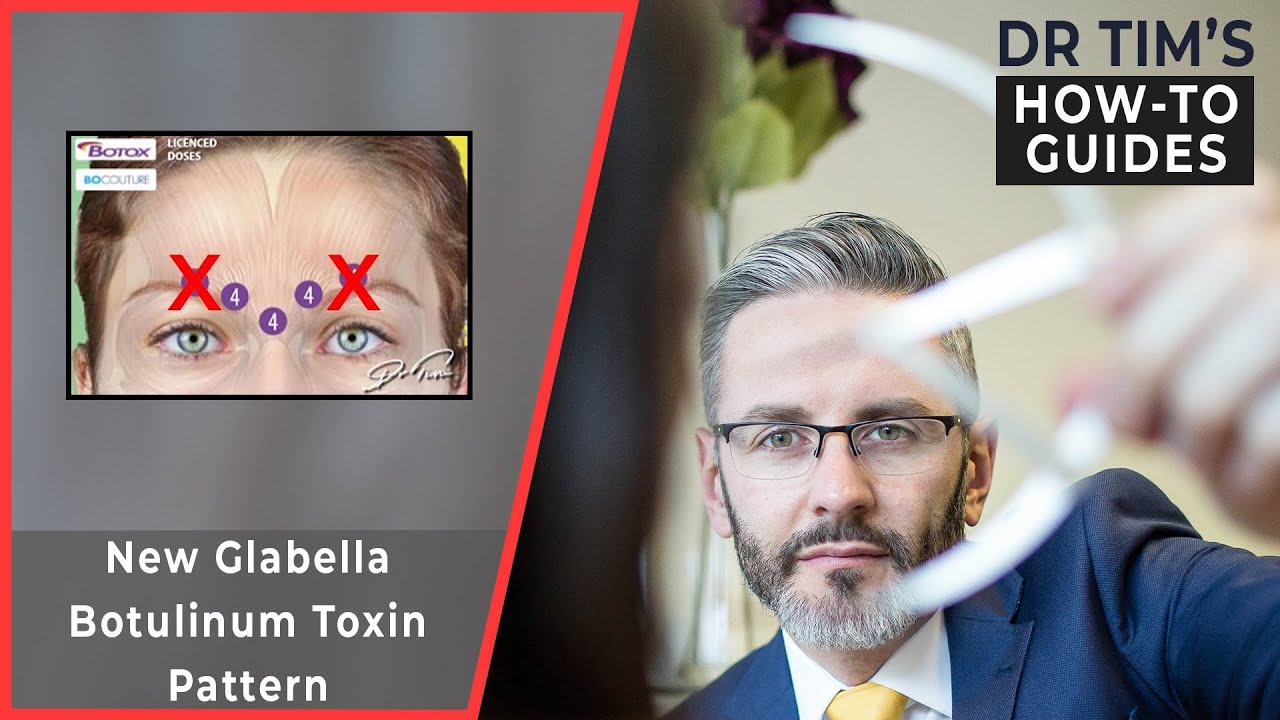 New Glabella Botulinum Toxin Pattern