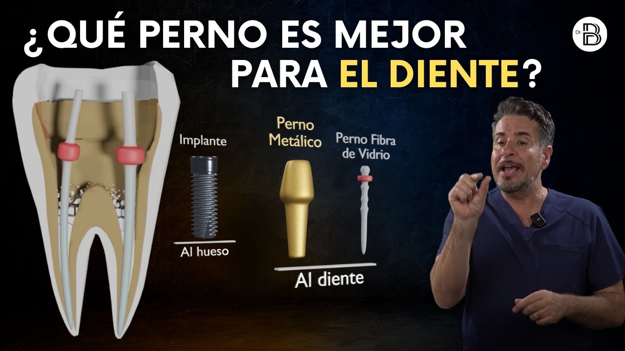 PERNO MET&Aacute;LICO vs. PERNO DE FIBRA DE VIDRIO: &iquest;Cu&aacute;l es la mejor opci&oacute;n para tu sonrisa?