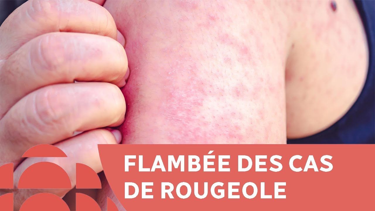 Rougeole : analyse de la maladie et l'importance de la vaccination