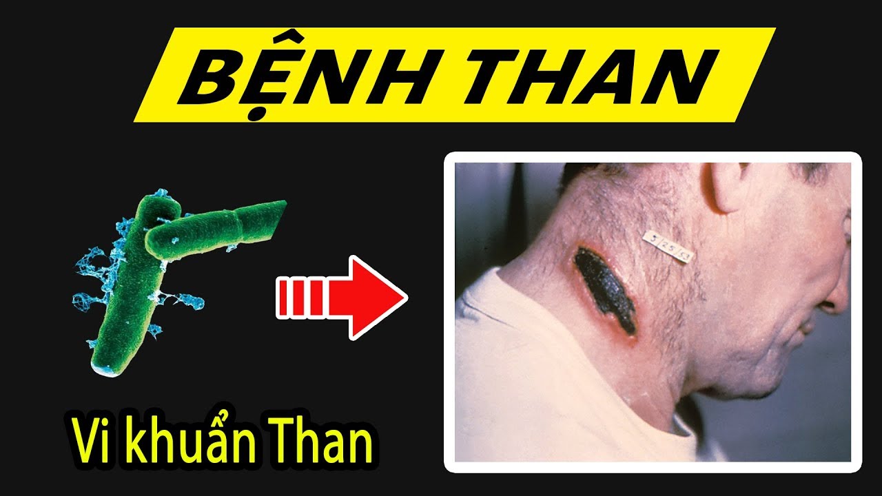Bệnh Than là gì mà xã hội xôn xao? Hiểu rõ trong 5 phút