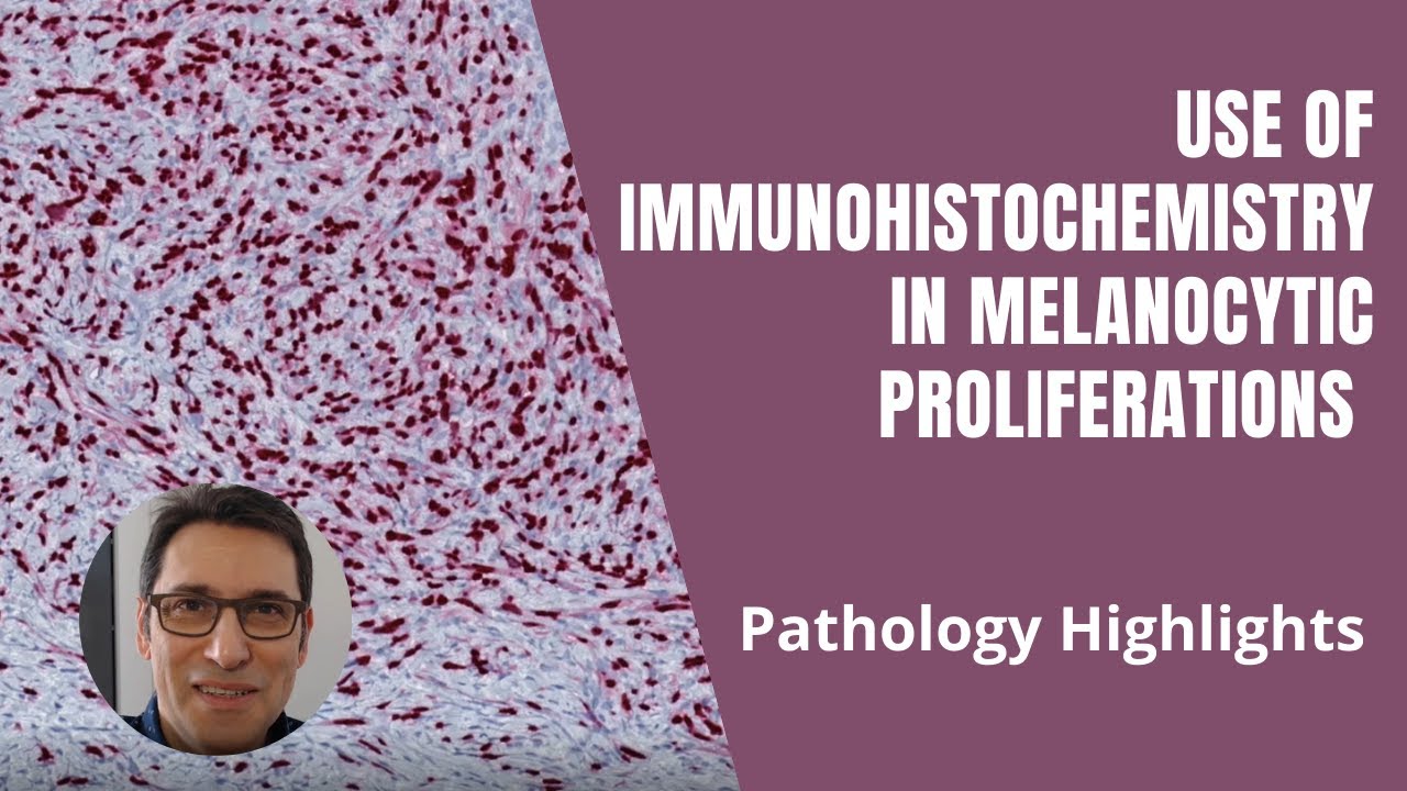 Immunohistochemistry (IHC) performed to confirm melanocytic lineage