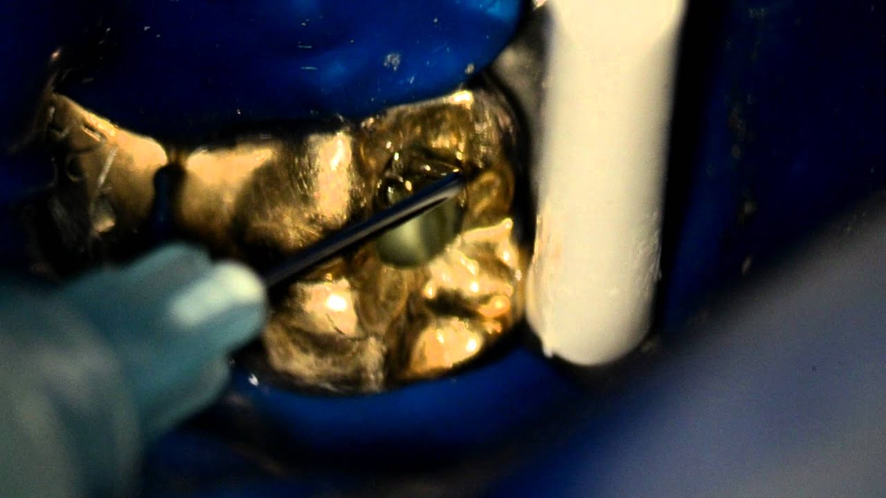 Use of Gates Glidden (GG) Burs in Root Canal Preparation