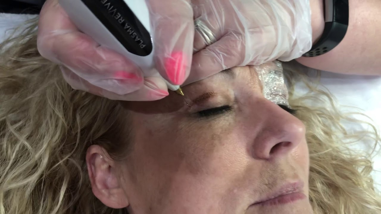 Plasma Eye Lift Treatment