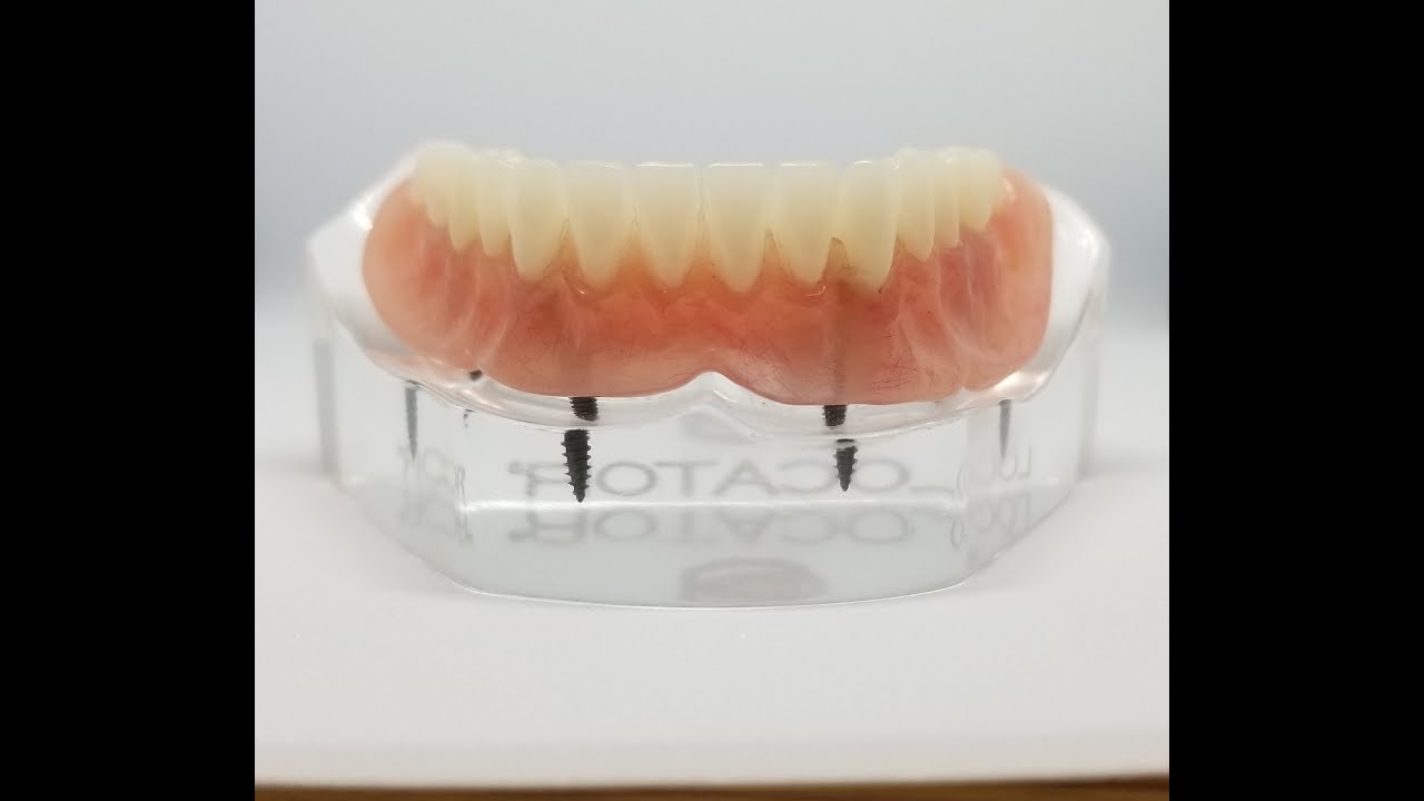 Lower denture implants