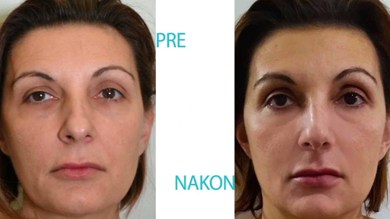 Zašto je podmlađivanje TwinLight laserom apsolutni HIT u poliklinici Diva dr Bogdanović?