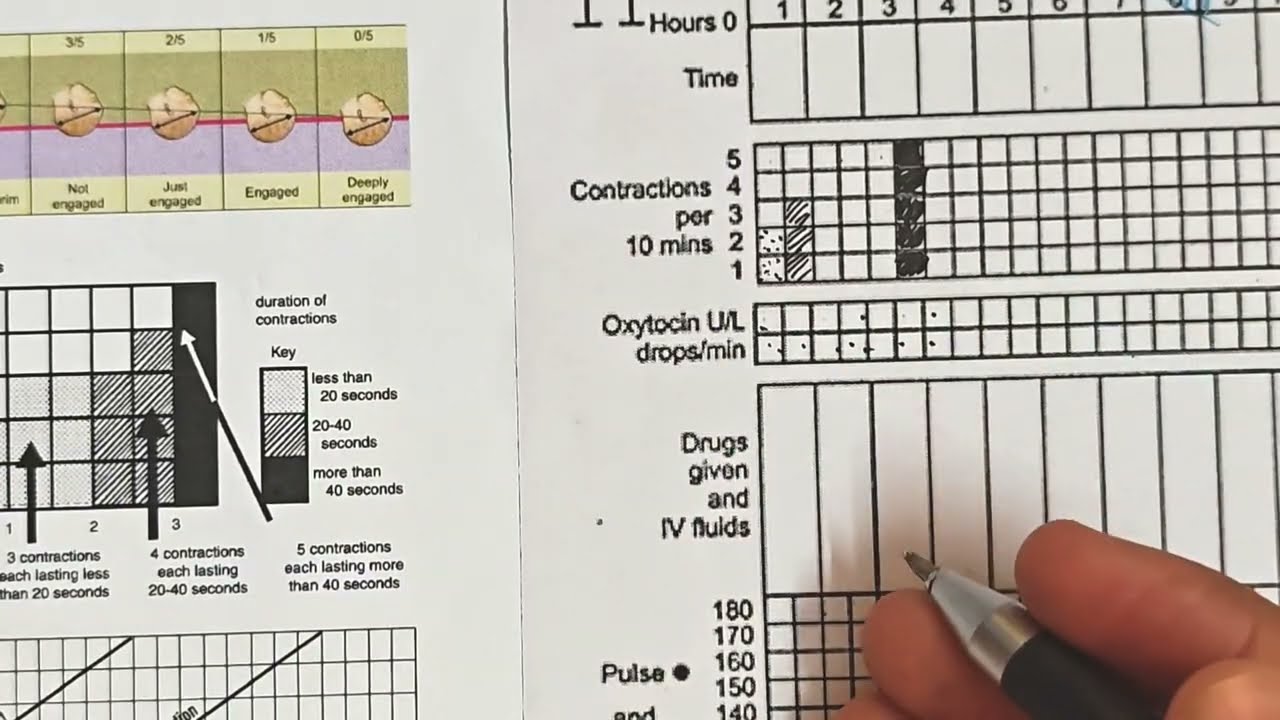 Partograph - Easy way to understand