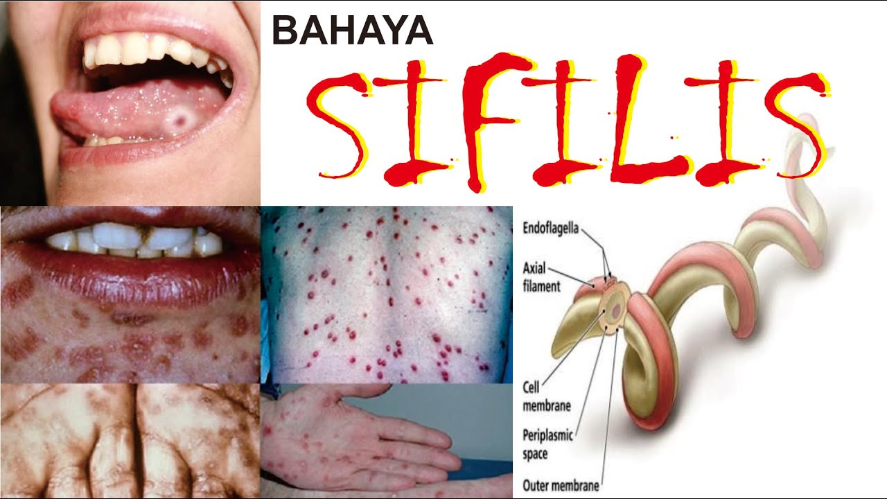 SIFILIS, Definisi, Penyebab, Gejala, Pengobatan dan Pencegahan