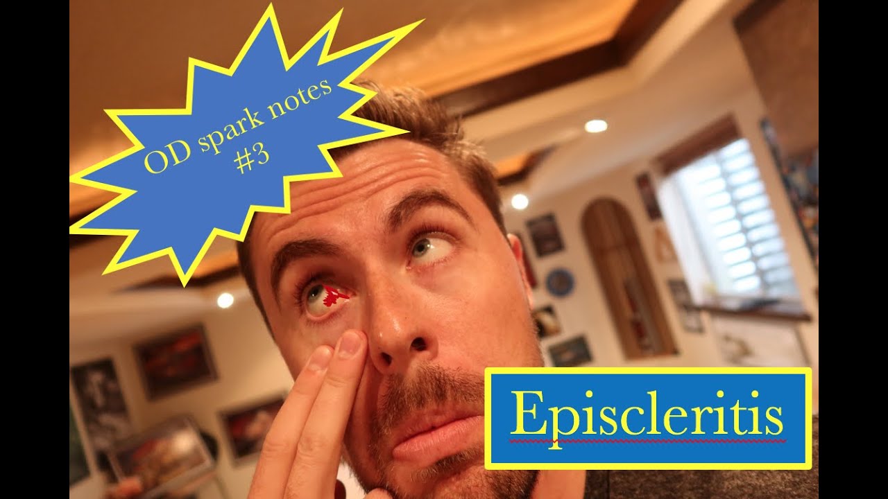Optometry Spark notes #3  - Episcleritis
