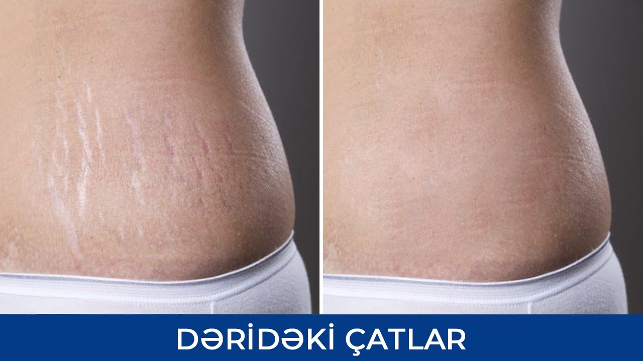 Dəridəki çatlaqlar - Hamiləlikdə çatlar - Ramil Qocayev (Dermatoveneroloq-kosmetoloq)