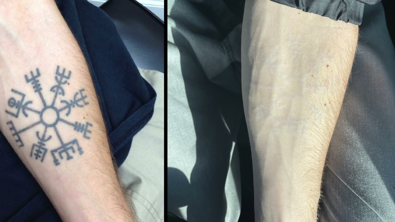 Before and After Laser Tattoo Removal