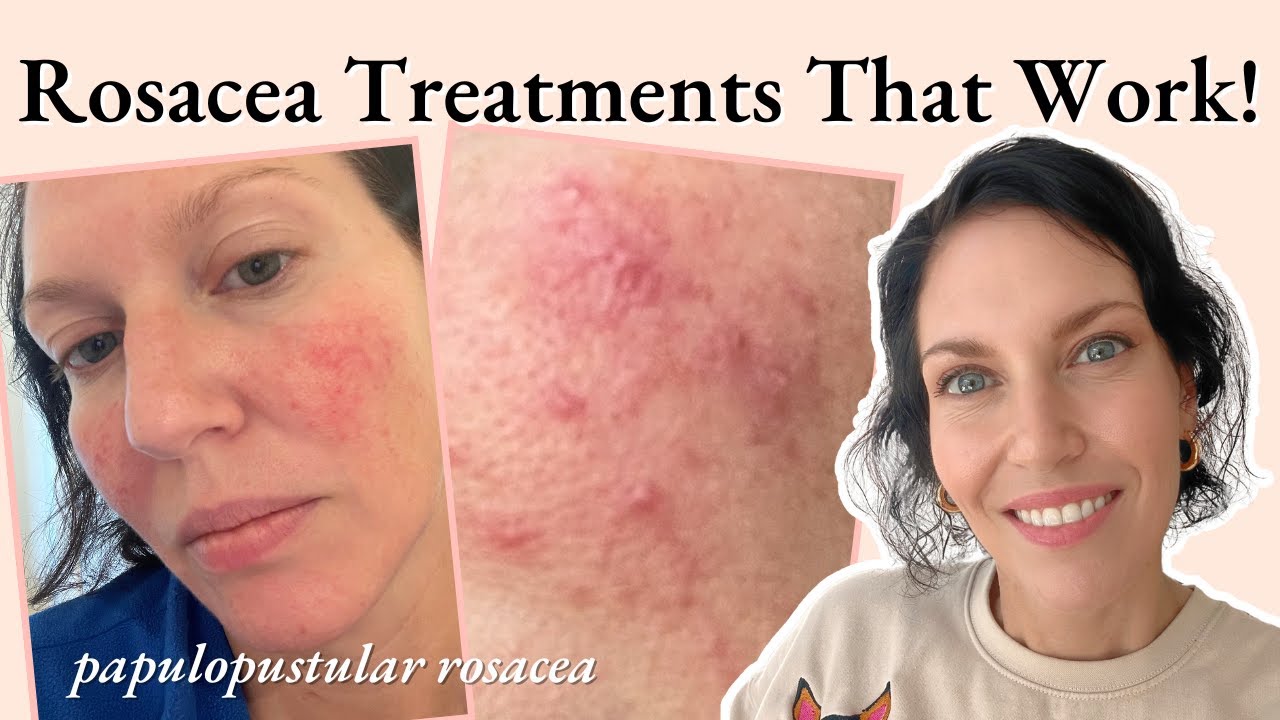ROSACEA relief revealed! Incredible Treatments You Need To Try!