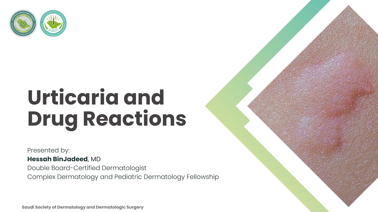Lecture 8 | Urticaria and Drug Reactions | Dr. Hessah BinJadeed