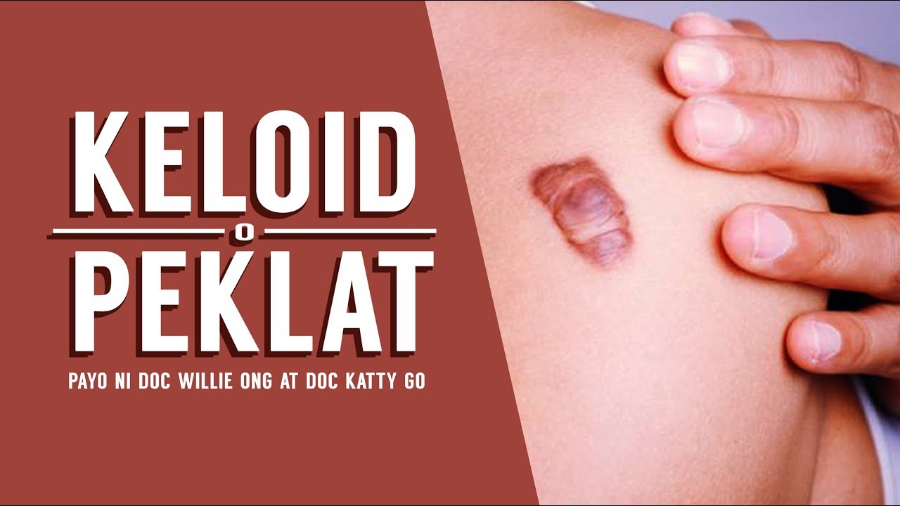 PEKLAT: Lunas sa Keloid - ni Dr Katty Go (Dermatologist) #29b