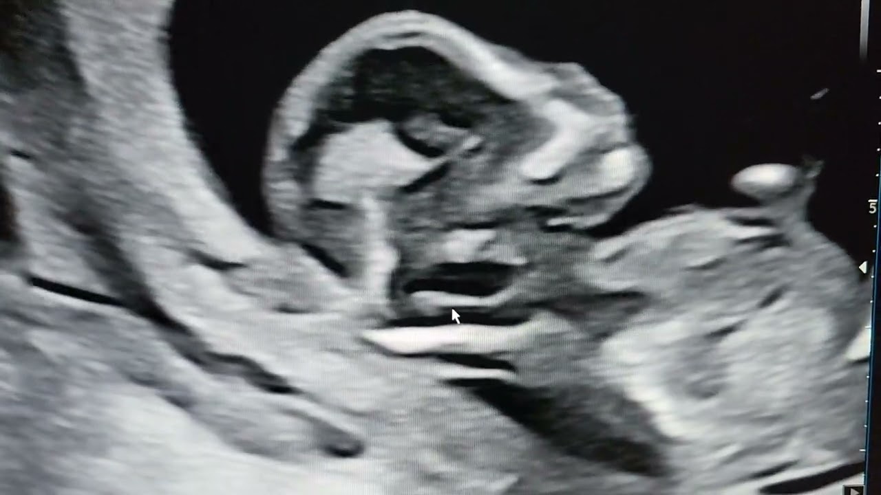 Open neural tube defect signs teaching in 12 week fetus.Dr Pradeep.REFER .