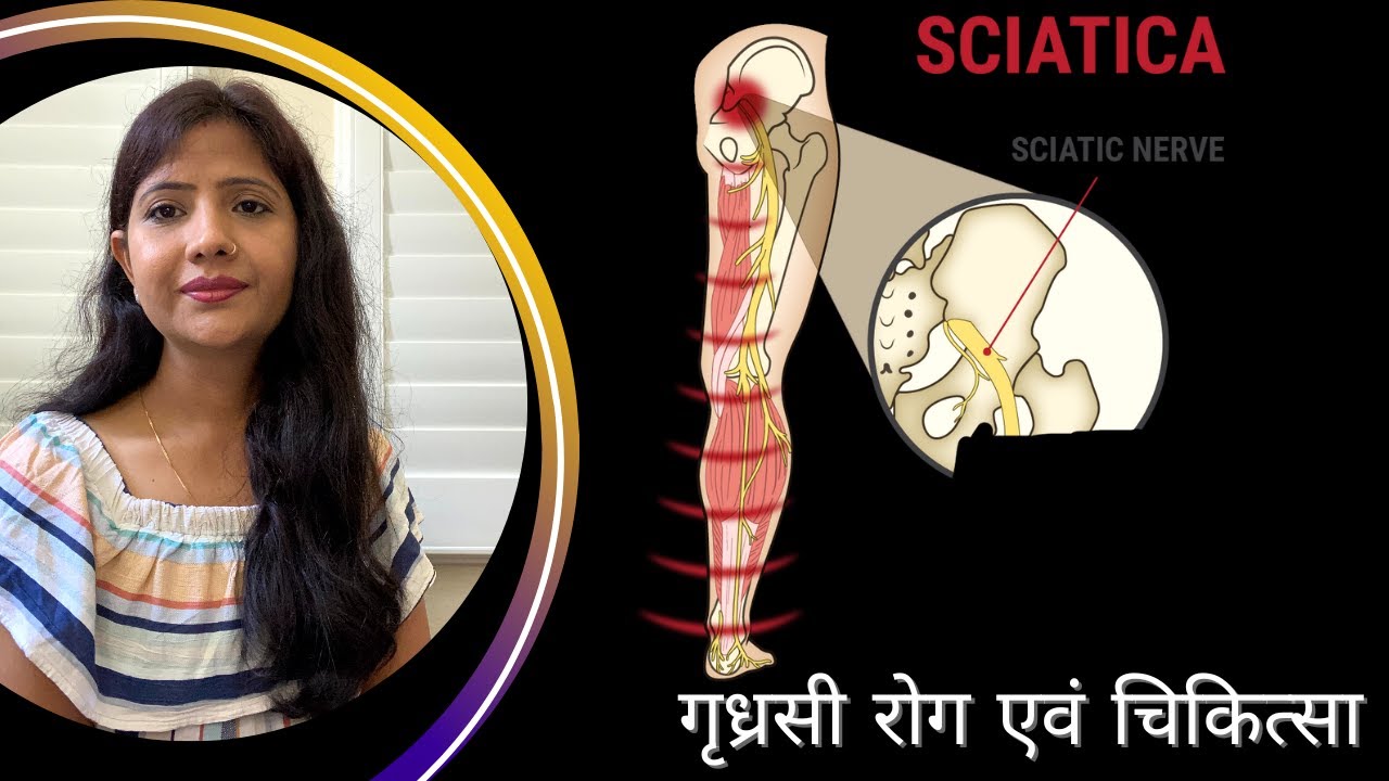 Sciatica Pain- causes-symptoms-diagnosis-treatment, Ayurveda Sciatica Disease- causes- symptoms-d...