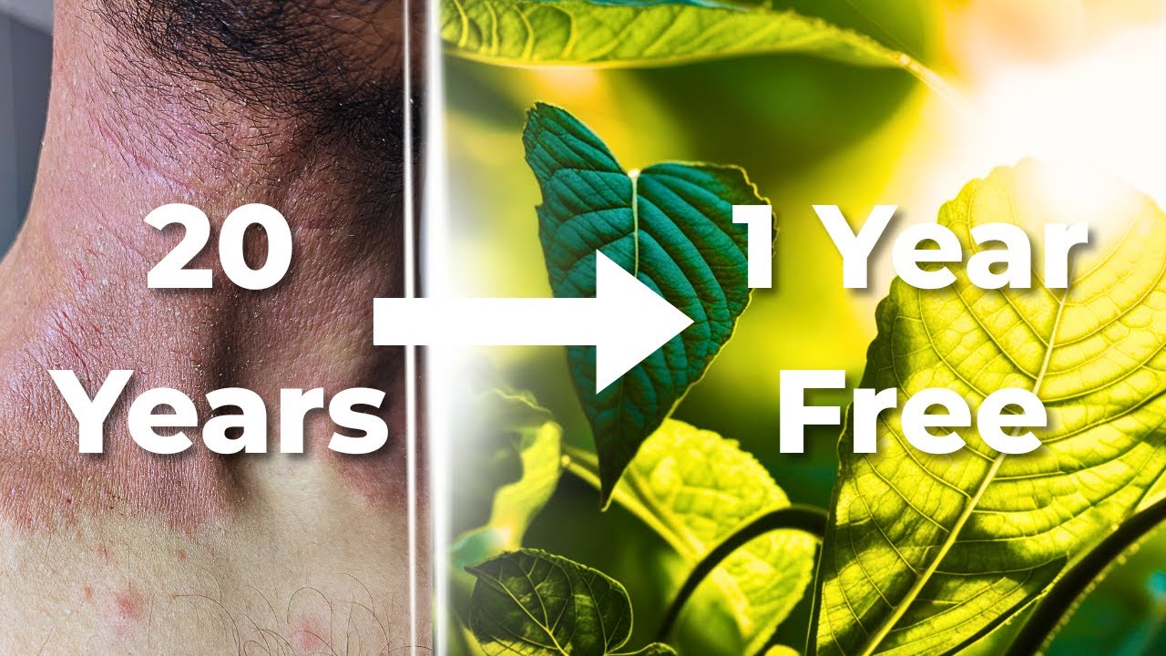 10 Years of Eczema, 1 Year Steroid-Free &mdash; My Raw, Unfiltered Journey