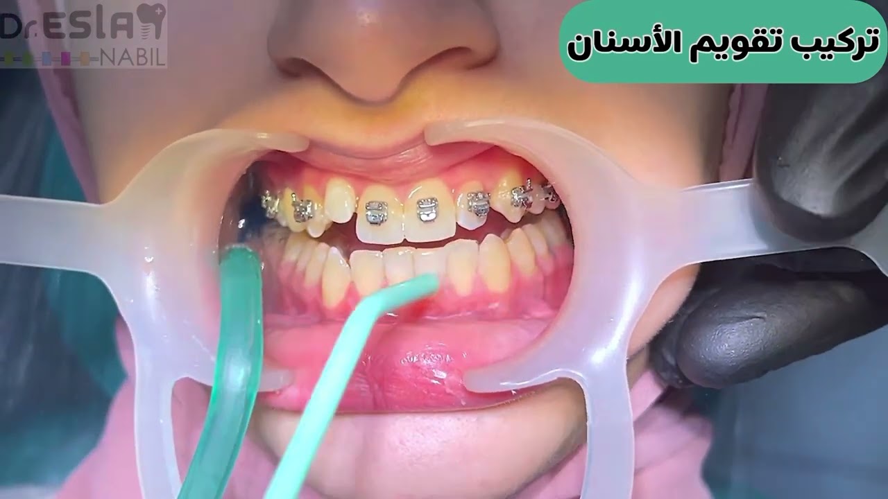 تركيب فصوص تقويم الاسنان | سلك التقويم