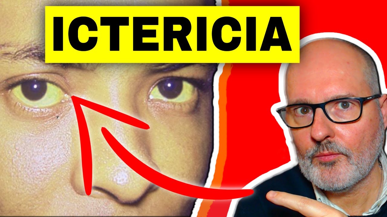 ICTERICIA 💥causas, síntomas, signos y analítica