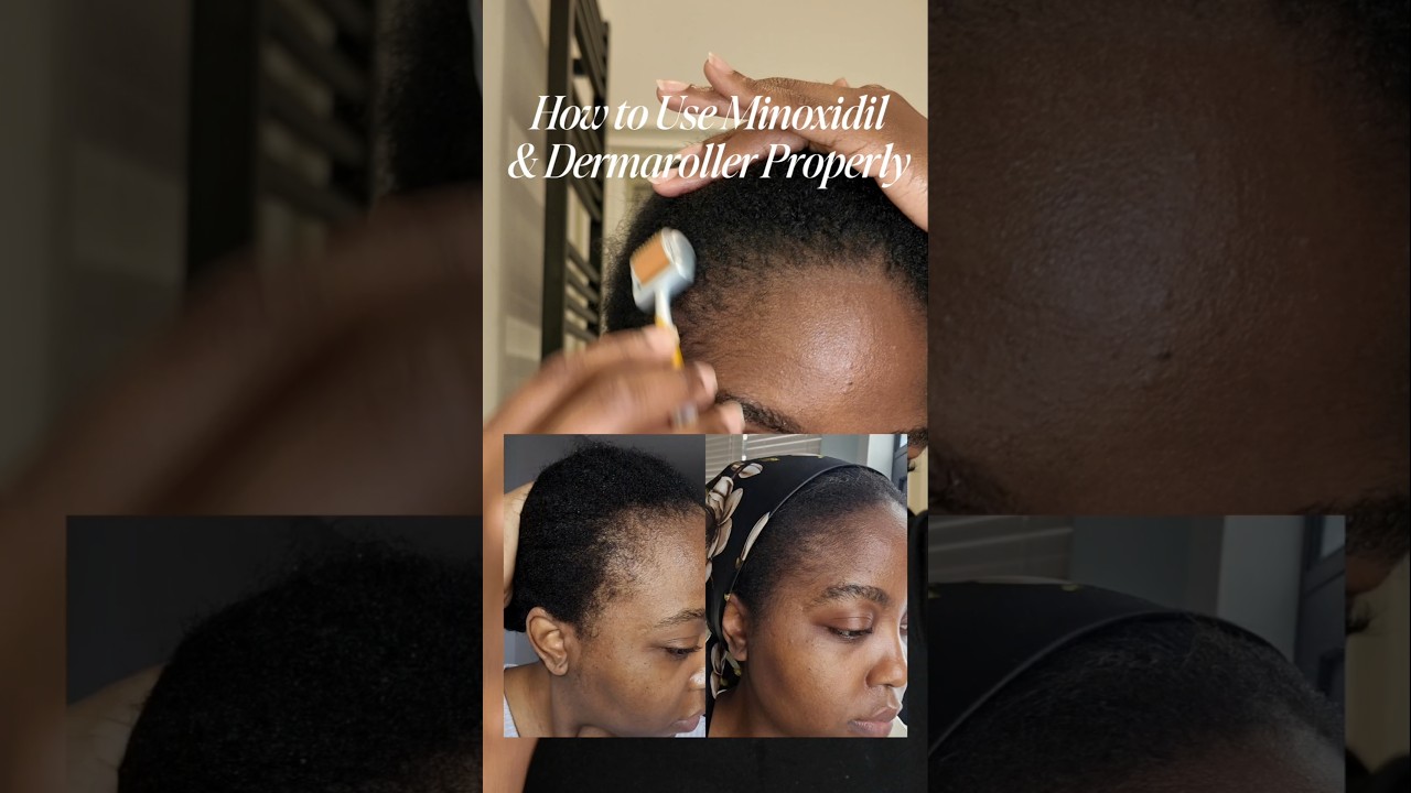 How to use Minoxidil and Dermaroller on edges 