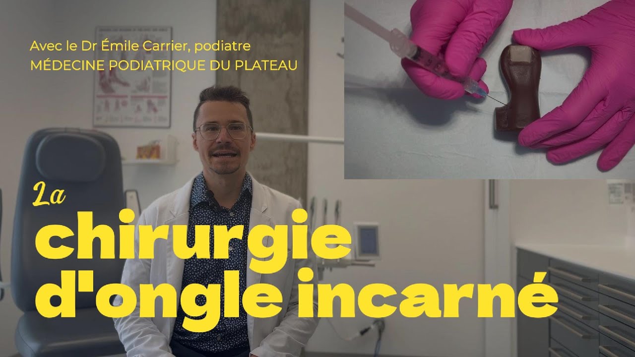 Tout savoir sur la chirurgie d’ongle incarné avec un podiatre à Gatineau (matricectomie/onycectomie)