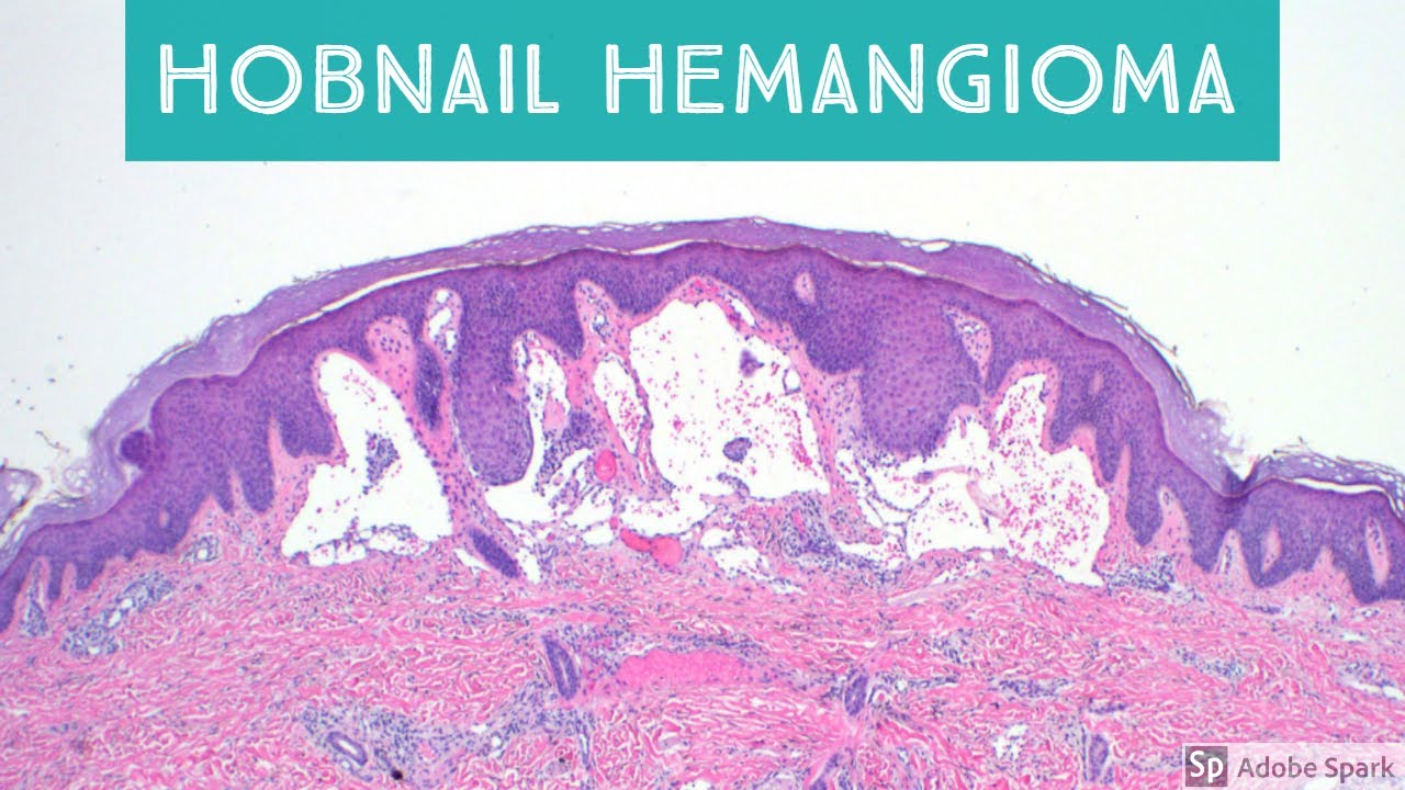 Hobnail Hemangioma (Targetoid Hemosiderotic Hemangioma), Retiform Hemangioendothelioma, and Mimics