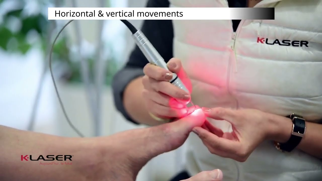 K-Laser - The 6 steps of toe fungus laser treatments