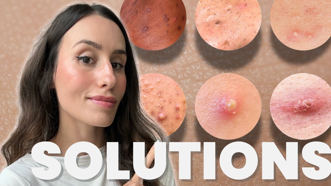 Comment identifier le type d'acné et trouver les soins idéaux ?