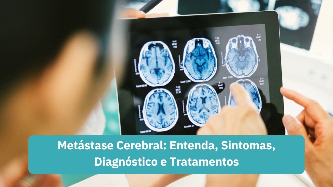 Metástase Cerebral: Entenda, Sintomas, Diagnóstico e Tratamentos