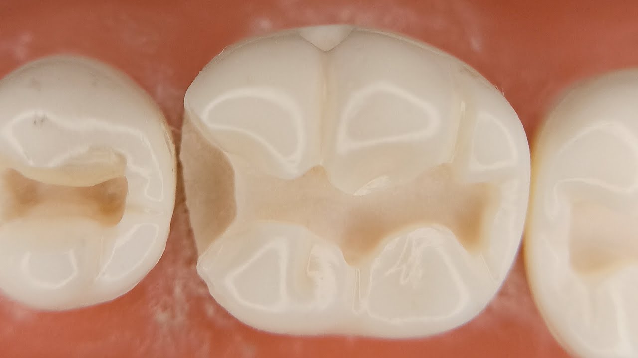Class II lower 6 cavity preparation