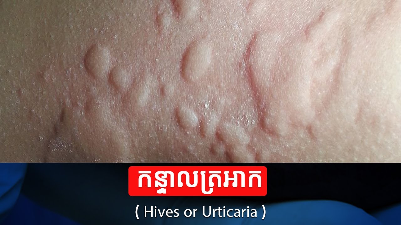 កន្ទាលត្រអាក​ ឬហៅថា​ Hives or Urticaria​ សង្ខេបខ្លីៗ​ | Health Problem | Health Care | Healthy Body