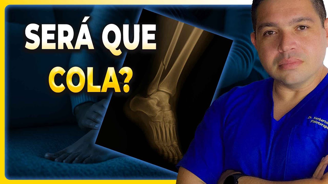 🦴 F&Iacute;BULA QUEBRADA SEM CIRURGIA... VAI COLAR?