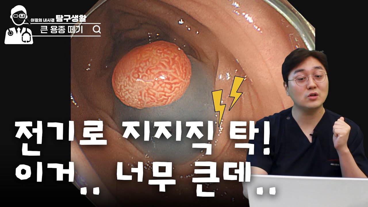 엄청 큰 용종 절제 후, 처리하는 방법