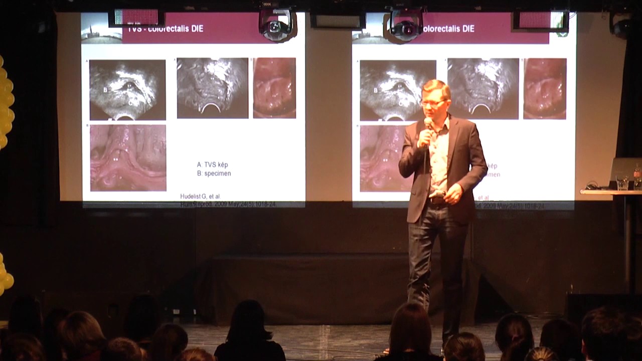 Endometriózis - TÉNYEK ÉS TÉVHITEK (Endometriózis Világnap 2017)