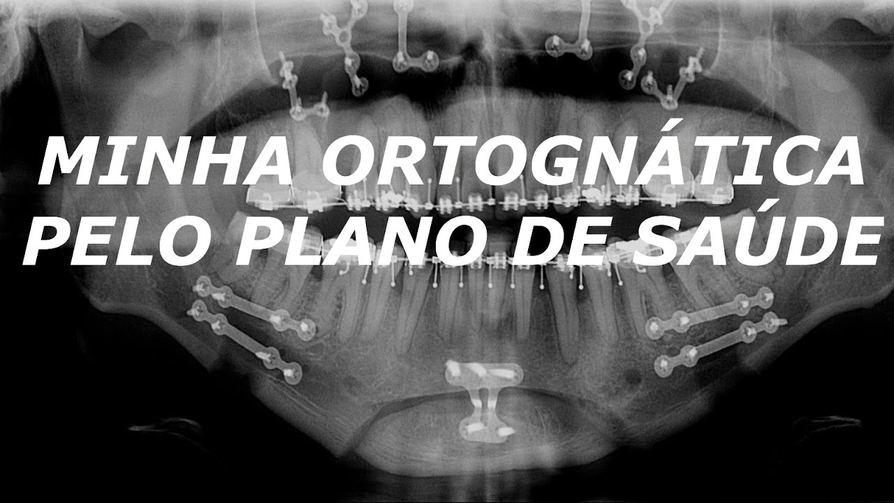MINHA ORTOGNÁTICA PELO PLANO DE SAÚDE