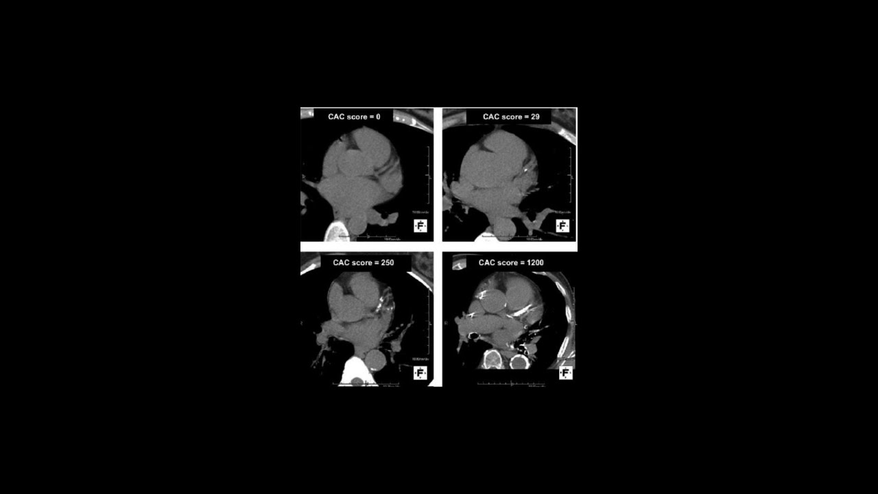 Coronary Artery Calcium scoring test