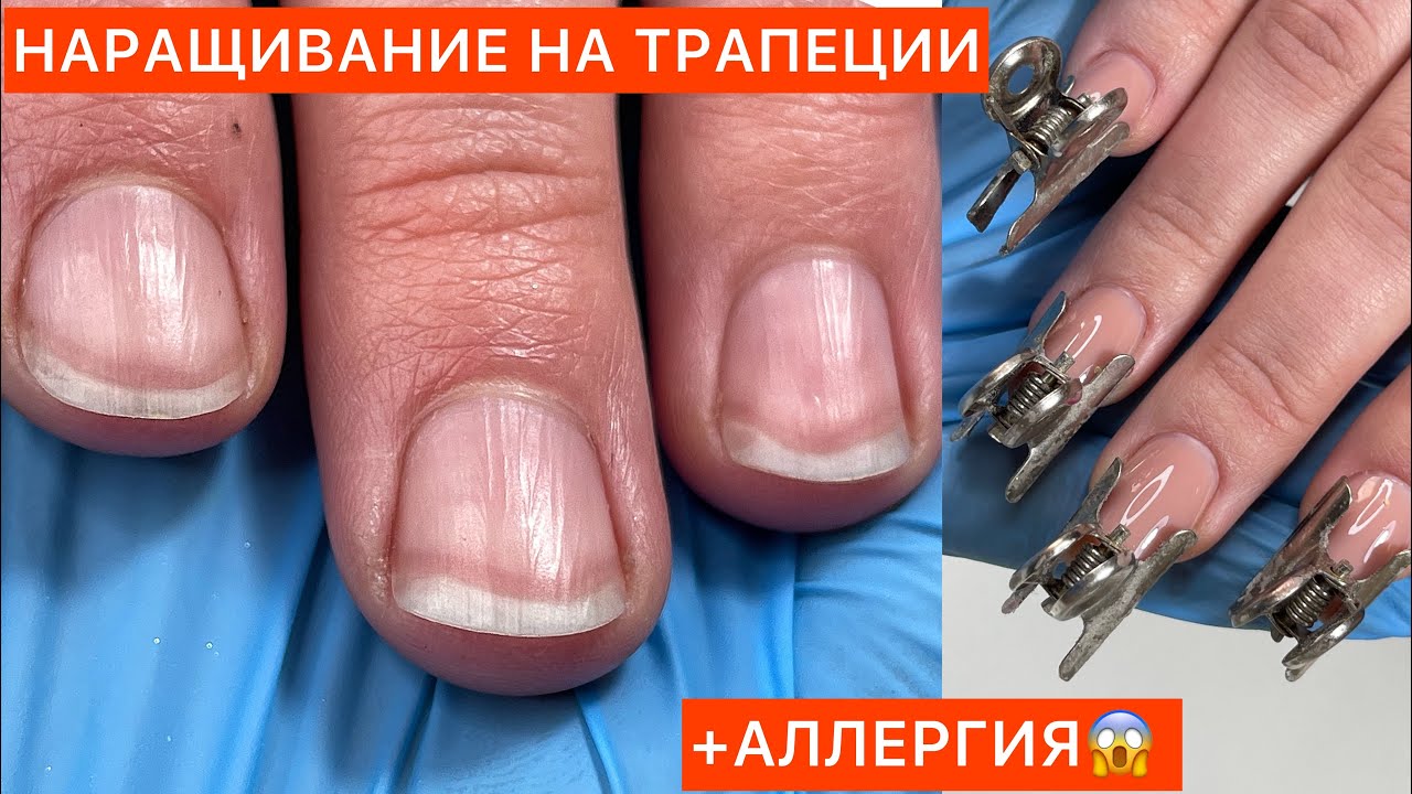 АЛЛЕРГИЯ НА ГЕЛЬ-ЛАК😱НАРАЩИВАНИЕ ТРАПЕЦИИ😤