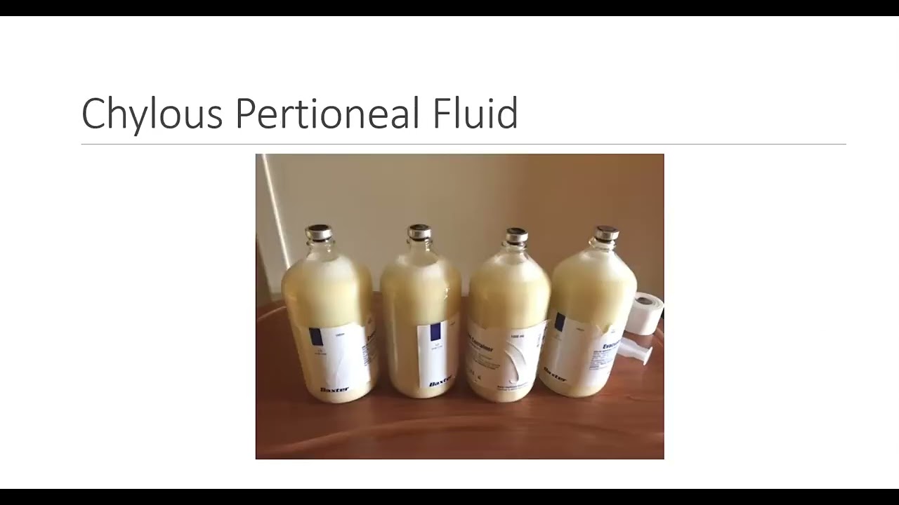 Ch 13   Serous   Pleural, Pericardial and Peritoneal Fluid Analysis