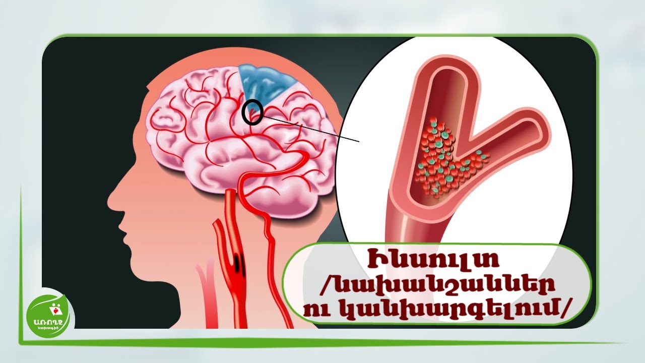 Ինսուլտ | Նախանշաններ ու Կանխարգելում / - #Առողջնախագիծ
