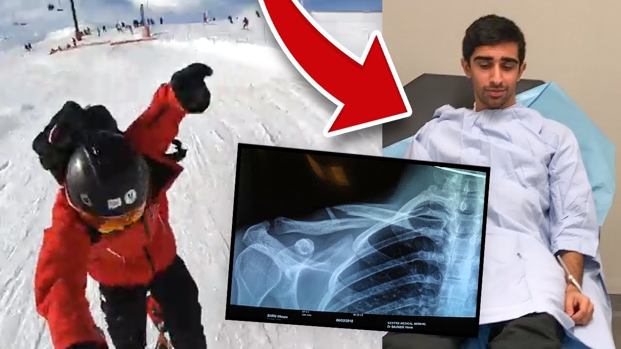 I BROKE MY COLLAR BONE - *LIVE FOOTAGE*
